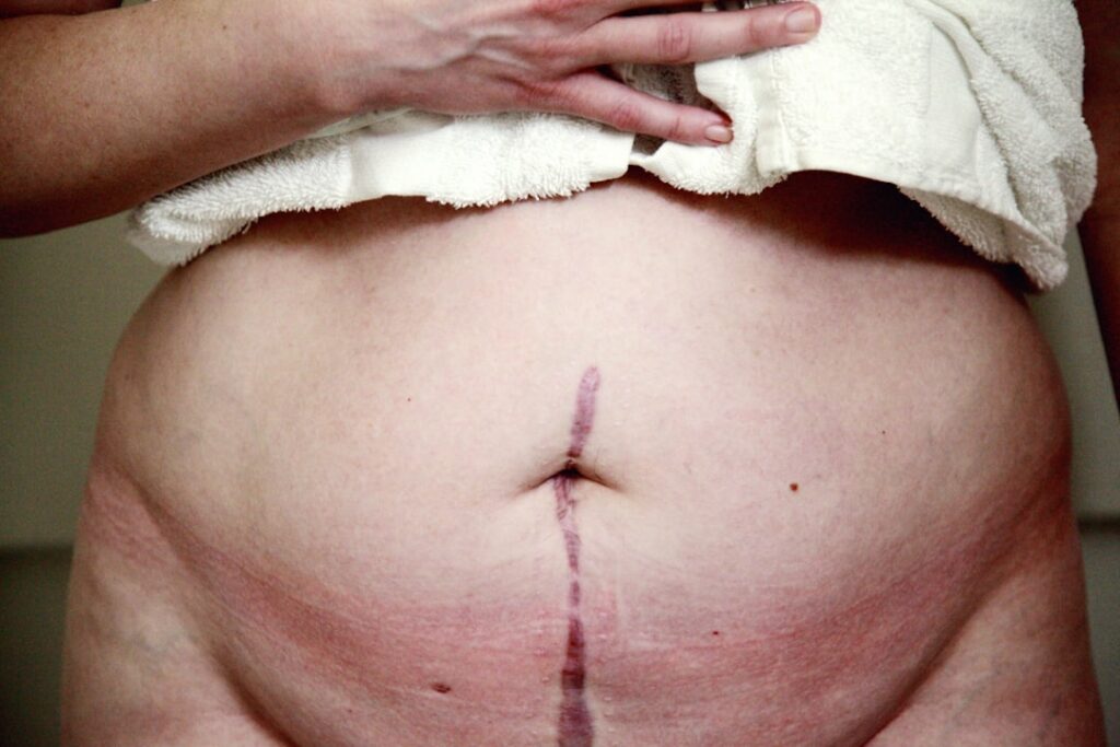 découvrez des méthodes efficaces et naturelles pour perdre la graisse abdominale rapidement et retrouver un ventre plat.