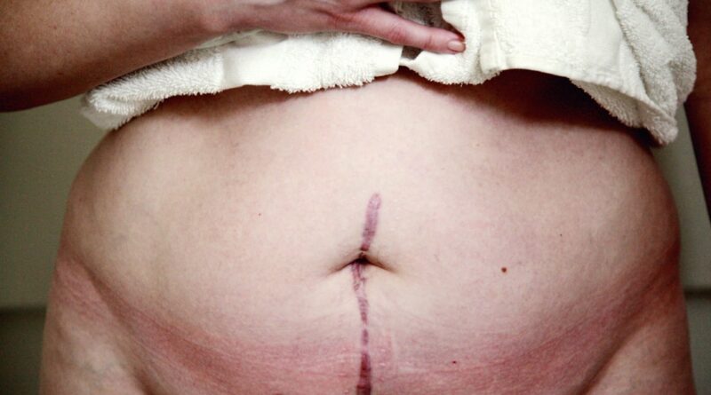 découvrez des méthodes efficaces et naturelles pour perdre la graisse abdominale rapidement et retrouver un ventre plat.